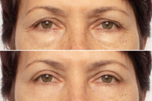 blefaroplastyka powiek