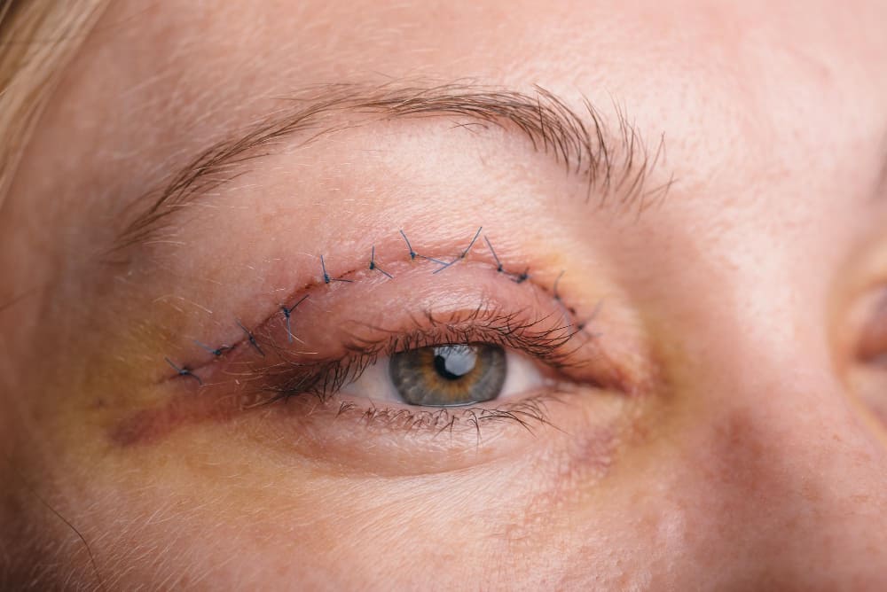 Redukcja blizn po blefaroplastyce